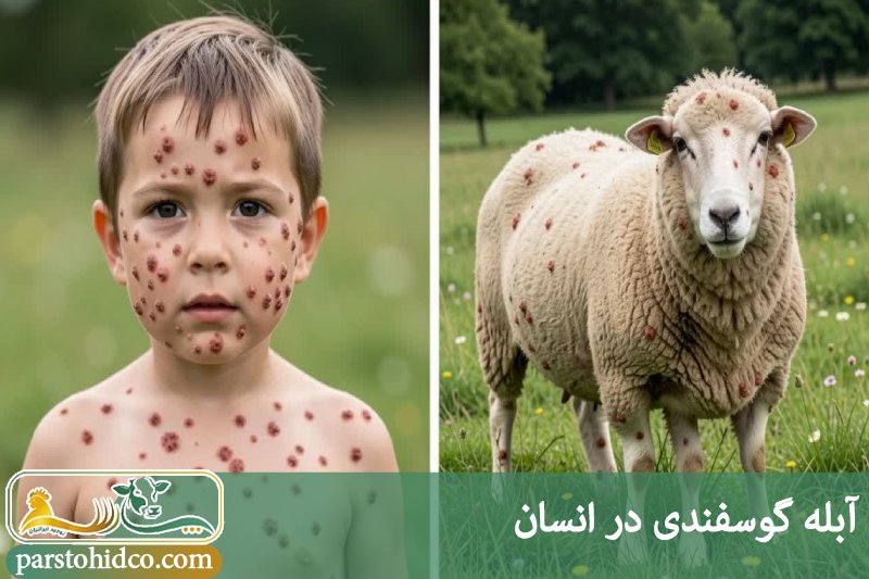 آبله گوسفندی در انسان 